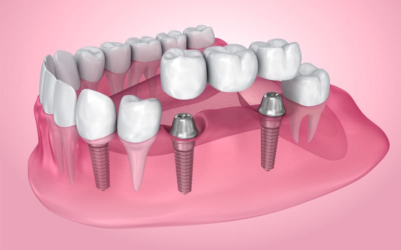 dental implants near you