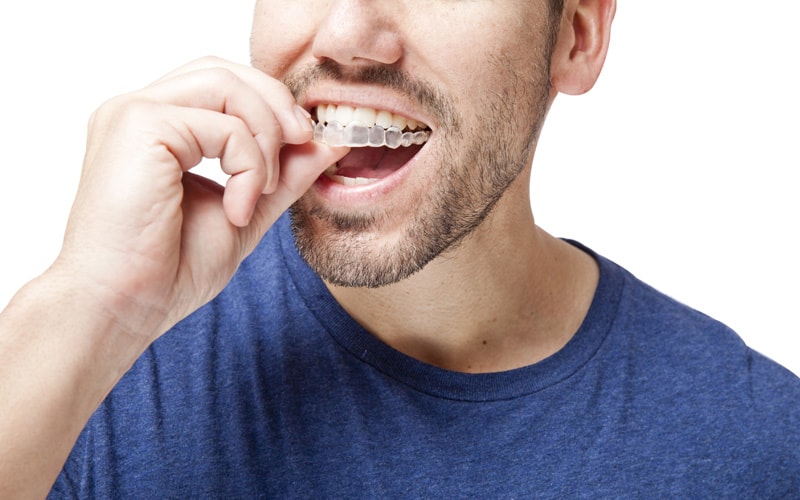 mouth guards in nw calgary