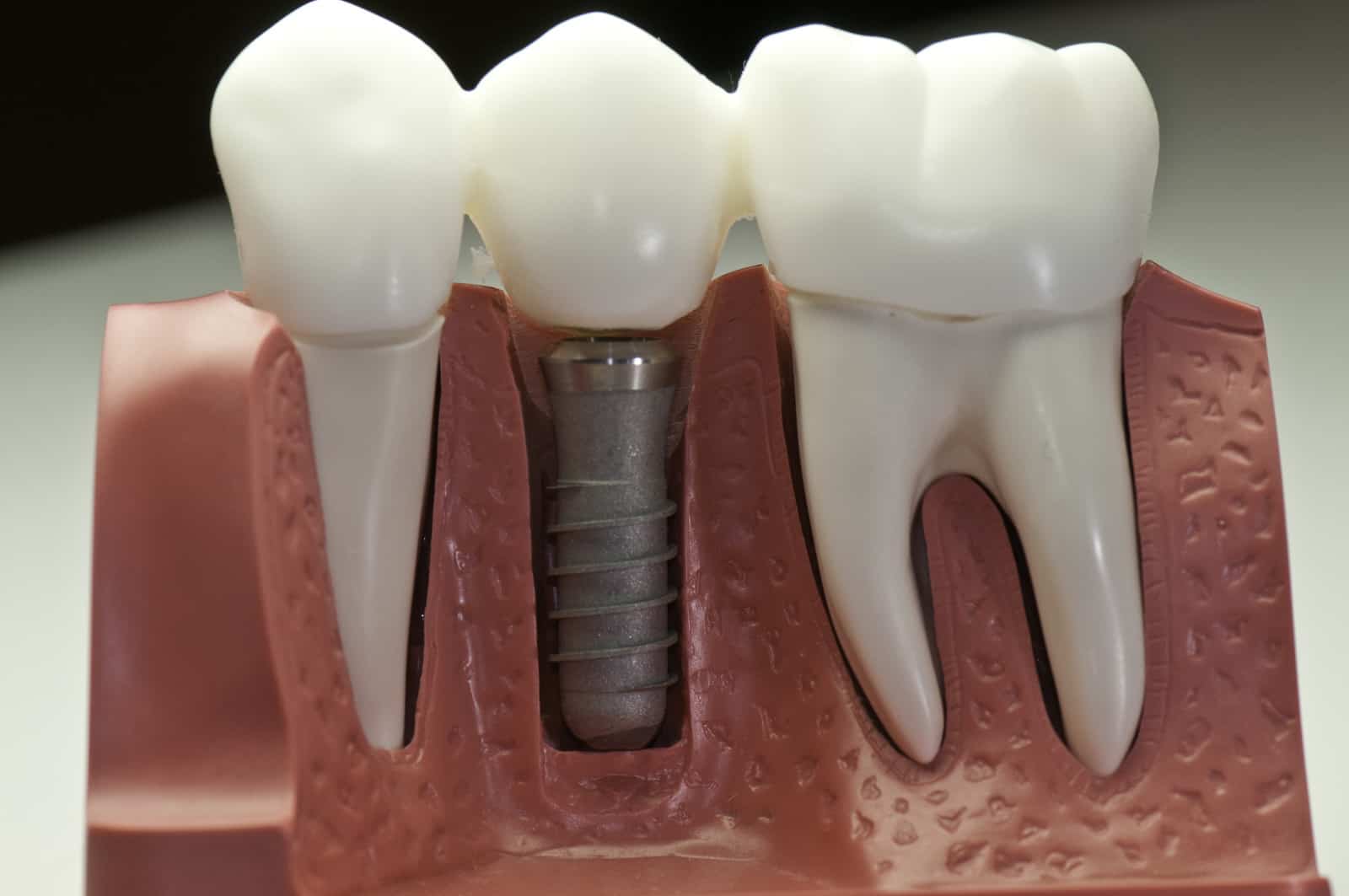 when can i eat after dental implant surgery?