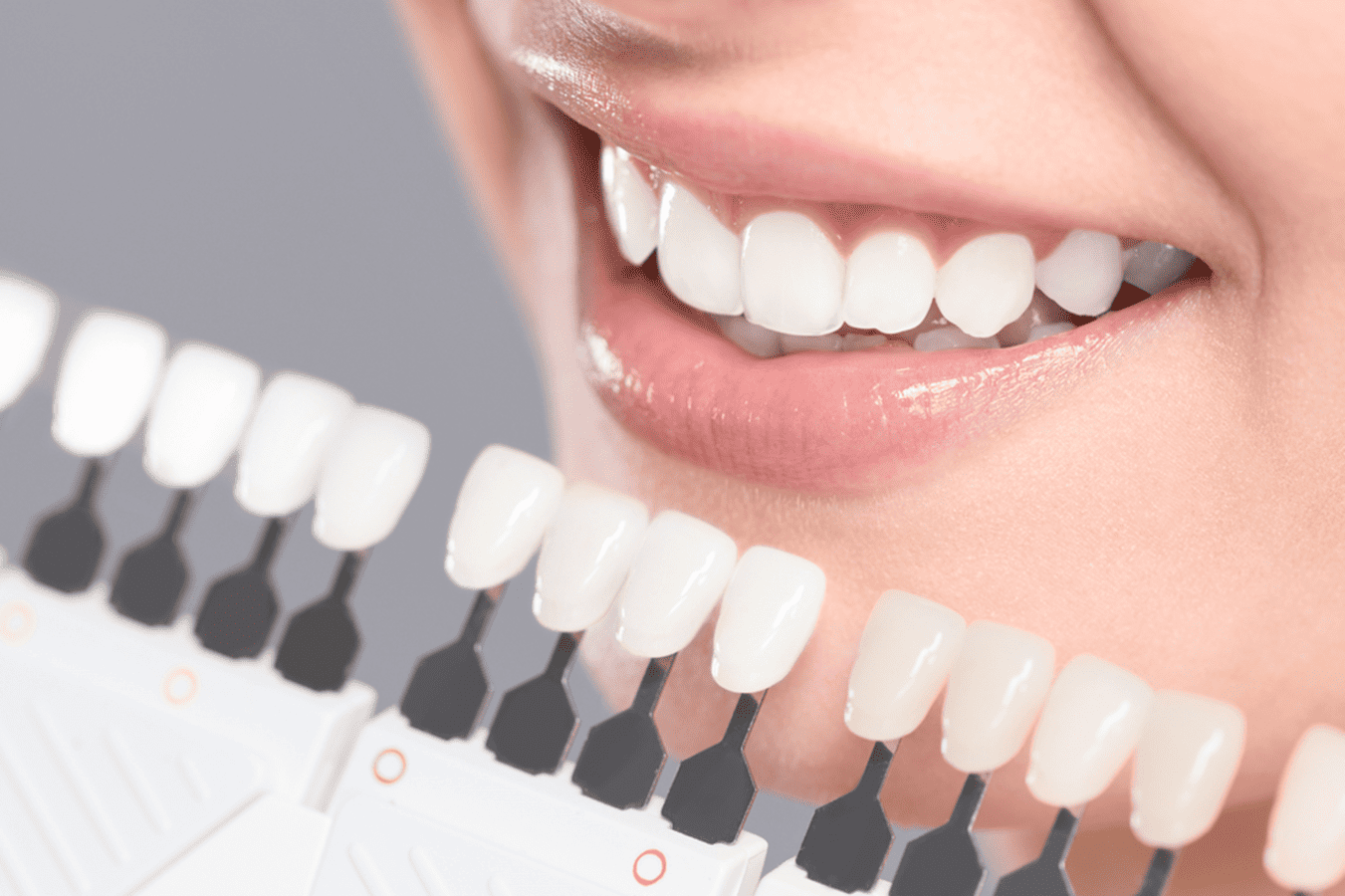 porcelain veneers