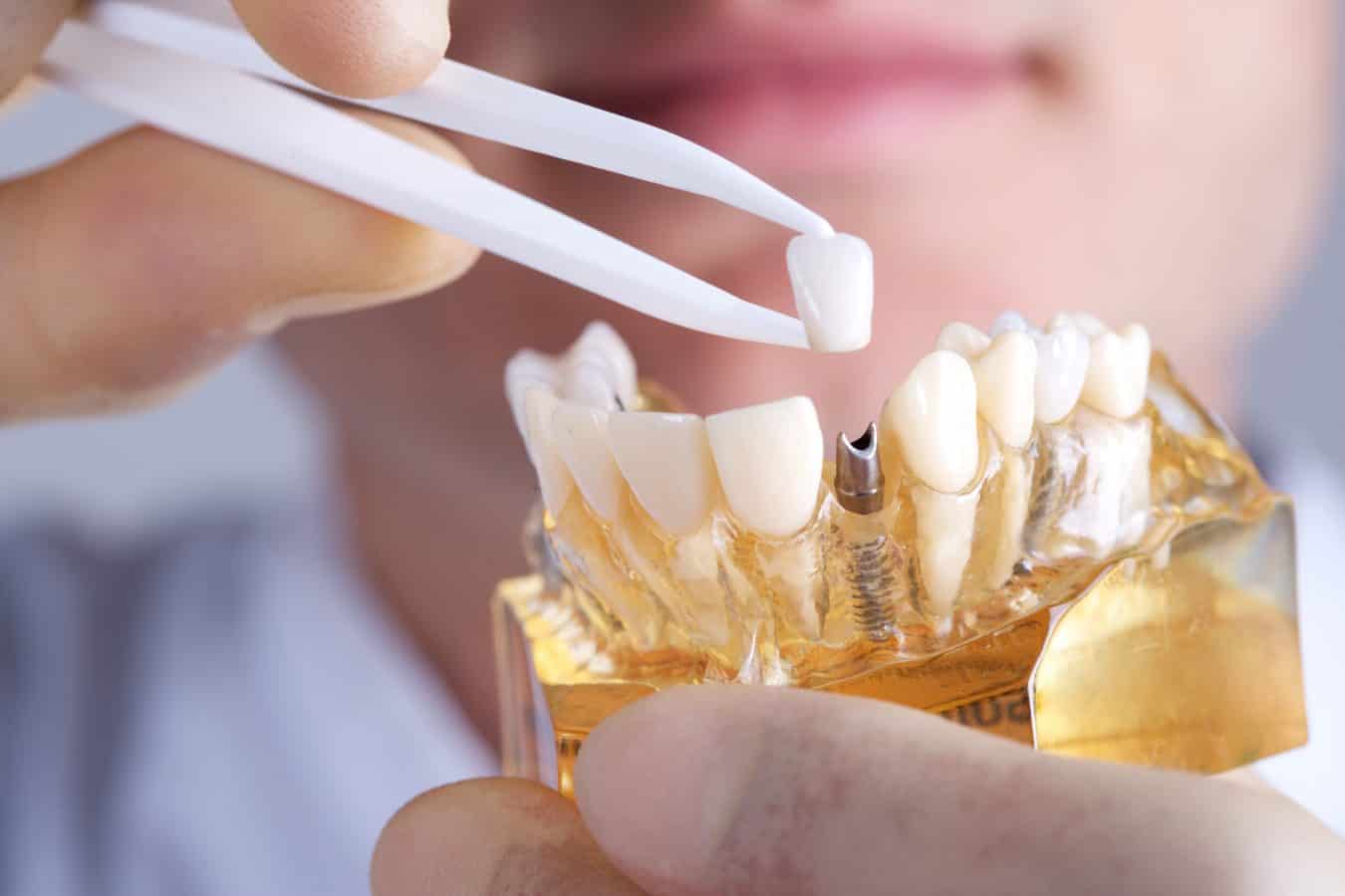 innovations in the dental implant industry