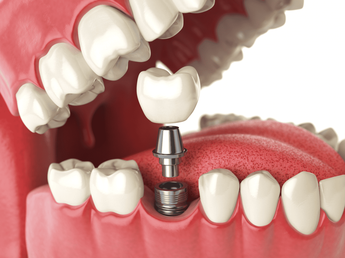 what to expect after dental implant procedure