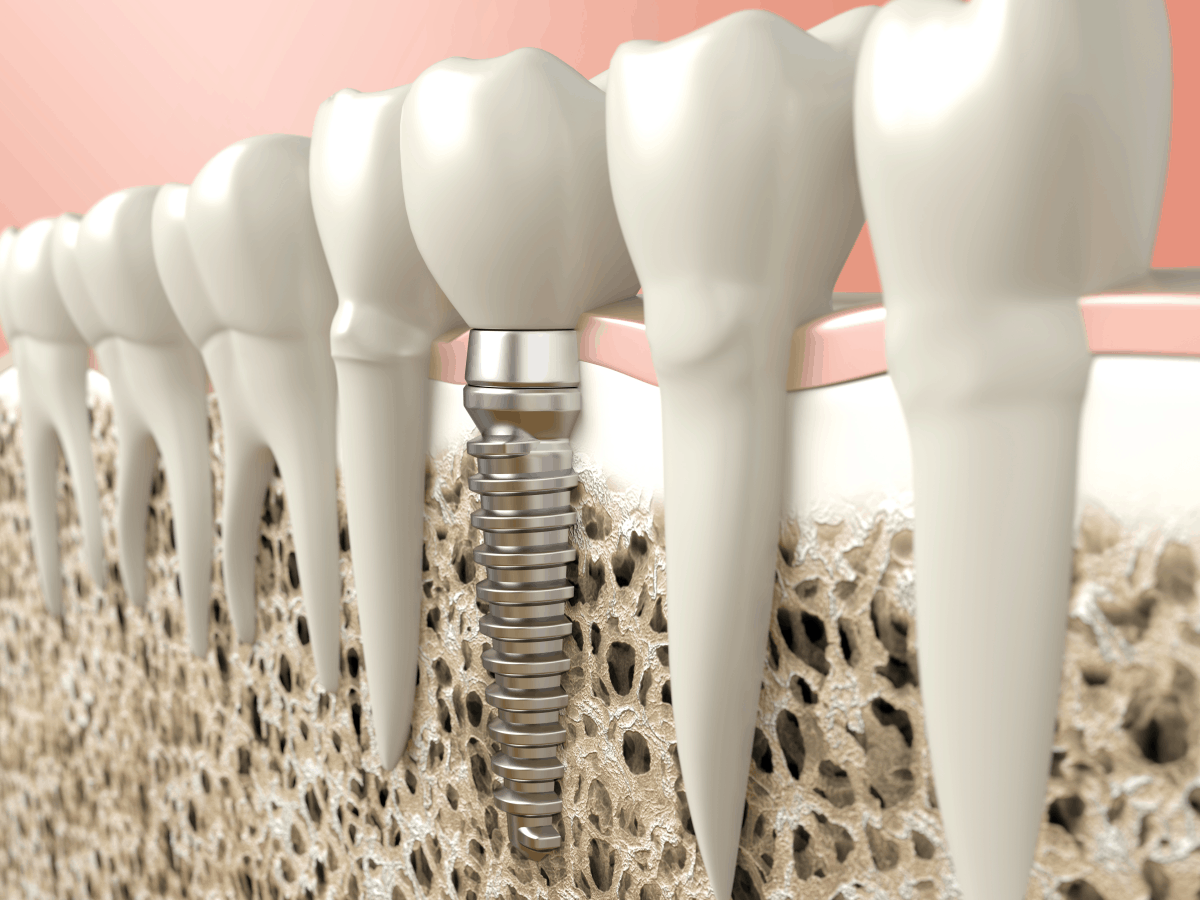 dental bridge vs implant how to know whats right for you