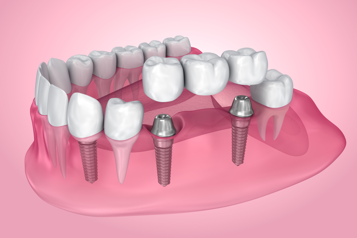 everything you need to know about dental bridges