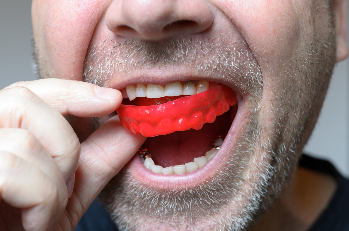 types of mouthguards which one is best for you