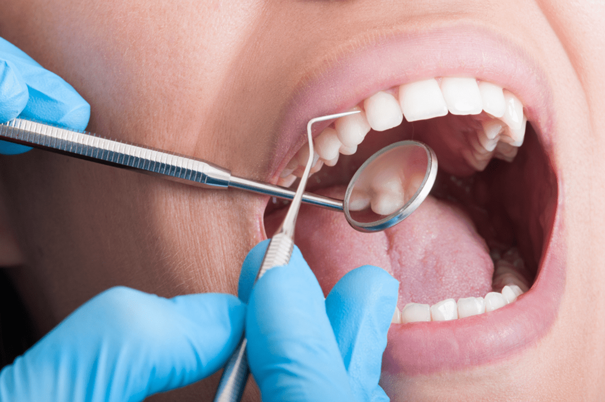 is teeth whitening effective on dental crowns