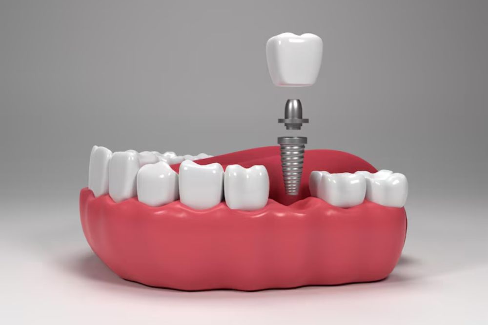 how-dental-implants-can-improve-your-smile-and-confidence