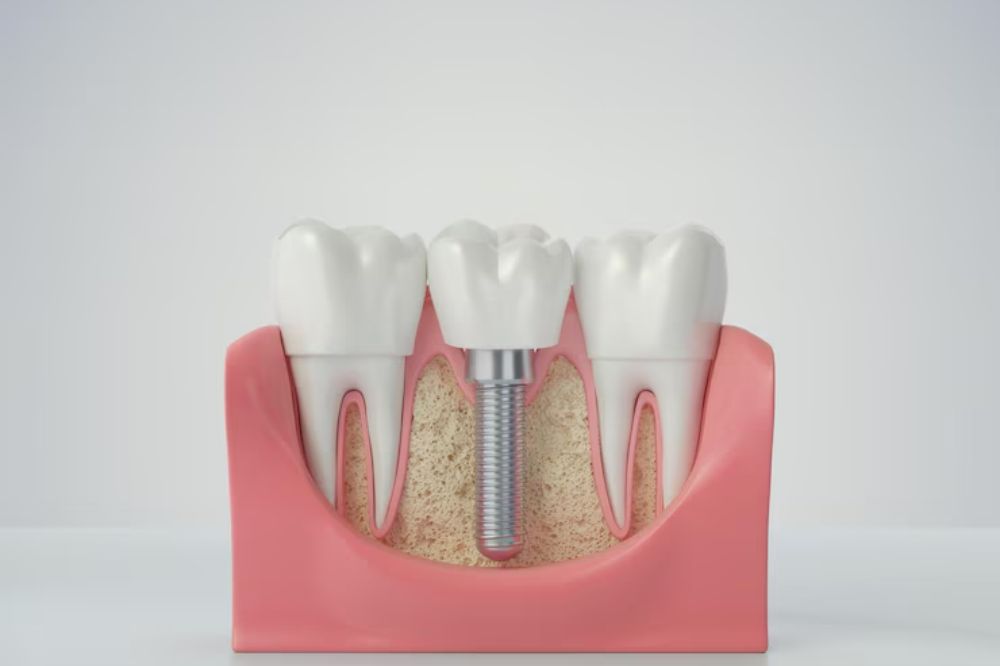 what-are-dental-implants-used-for-a-look-at-their-function-and-advantages