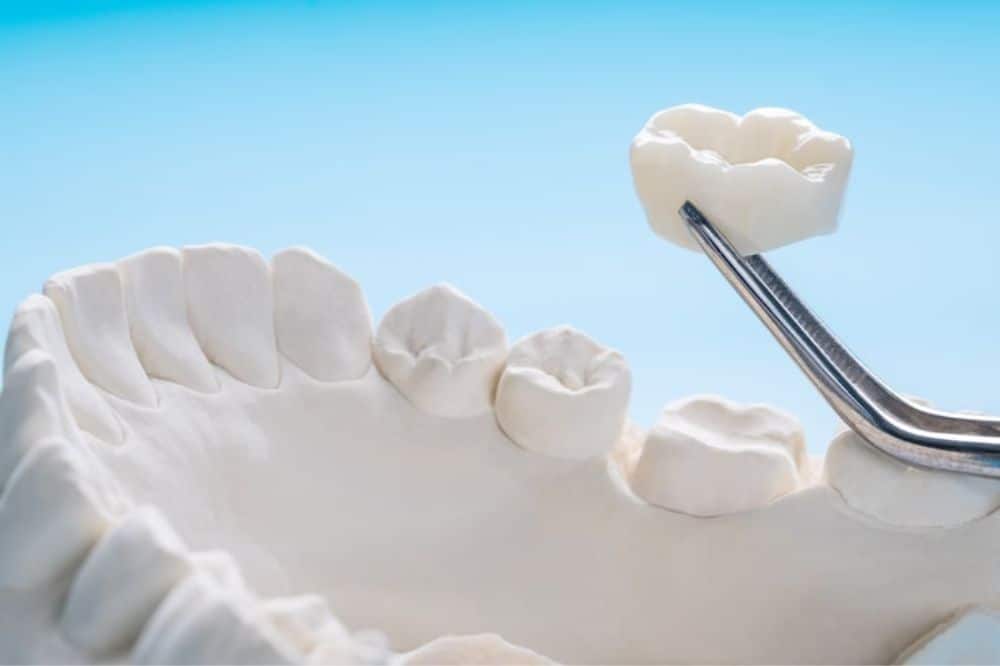Understanding Dental Crowns: A Complete Patient Guide