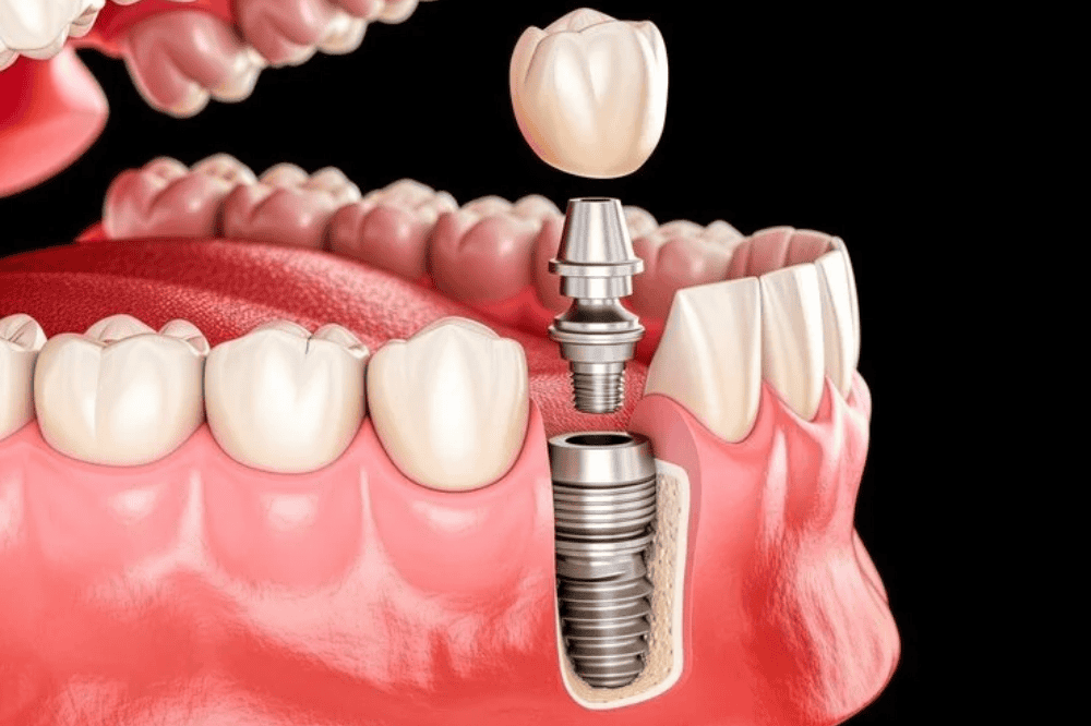 How Much Do Dental Implants Cost?